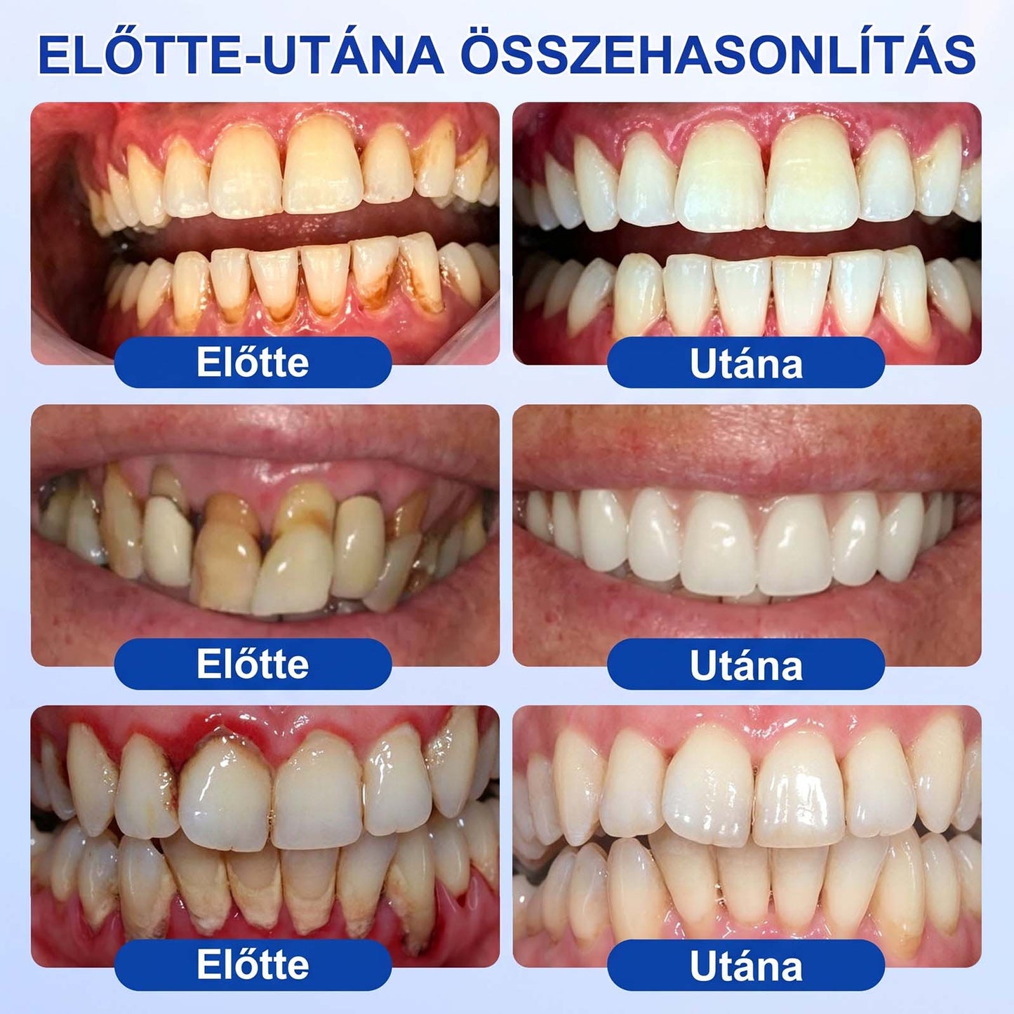 PureShade® 🦷 GumRevive Ínyregeneráló Gél – Az egészségesebb ínyért és magabiztosabb mosolyért 👍