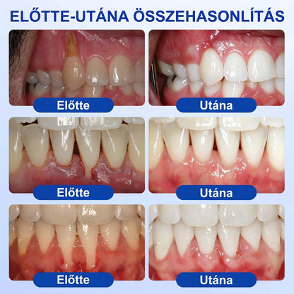 PureShade® 🦷 GumRevive Ínyregeneráló Gél – Az egészségesebb ínyért és magabiztosabb mosolyért 👍