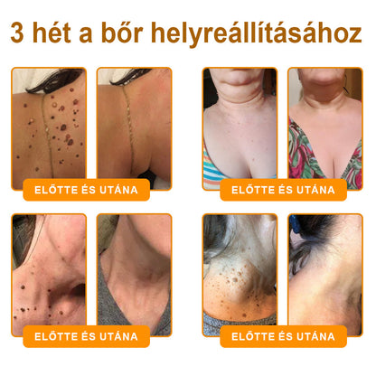 Fájdalommentesen és hatékonyan távolítja el a különböző szemölcsökety👨‍⚕️ APKAPK® Méhméreg Bőrmegújító Krém segít eltávolítani a közönséges, talpi, lapos és fonalas szemölcsöket, valamint a papillómákat