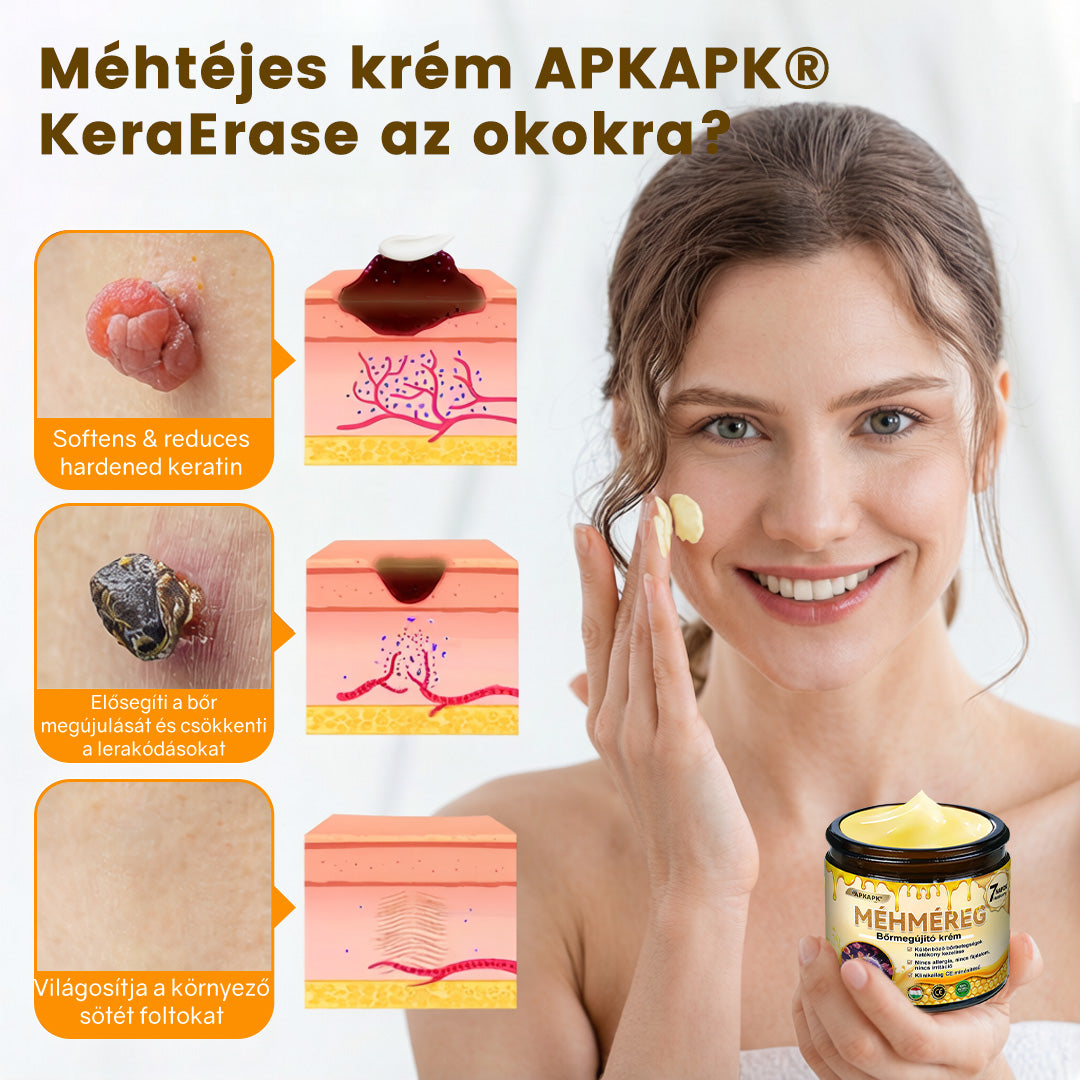 Fájdalommentesen és hatékonyan távolítja el a különböző szemölcsökety👨‍⚕️ APKAPK® Méhméreg Bőrmegújító Krém segít eltávolítani a közönséges, talpi, lapos és fonalas szemölcsöket, valamint a papillómákat