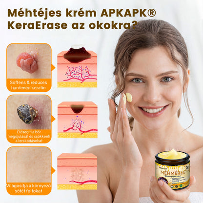 Fájdalommentesen és hatékonyan távolítja el a különböző szemölcsökety👨‍⚕️ APKAPK® Méhméreg Bőrmegújító Krém segít eltávolítani a közönséges, talpi, lapos és fonalas szemölcsöket, valamint a papillómákat