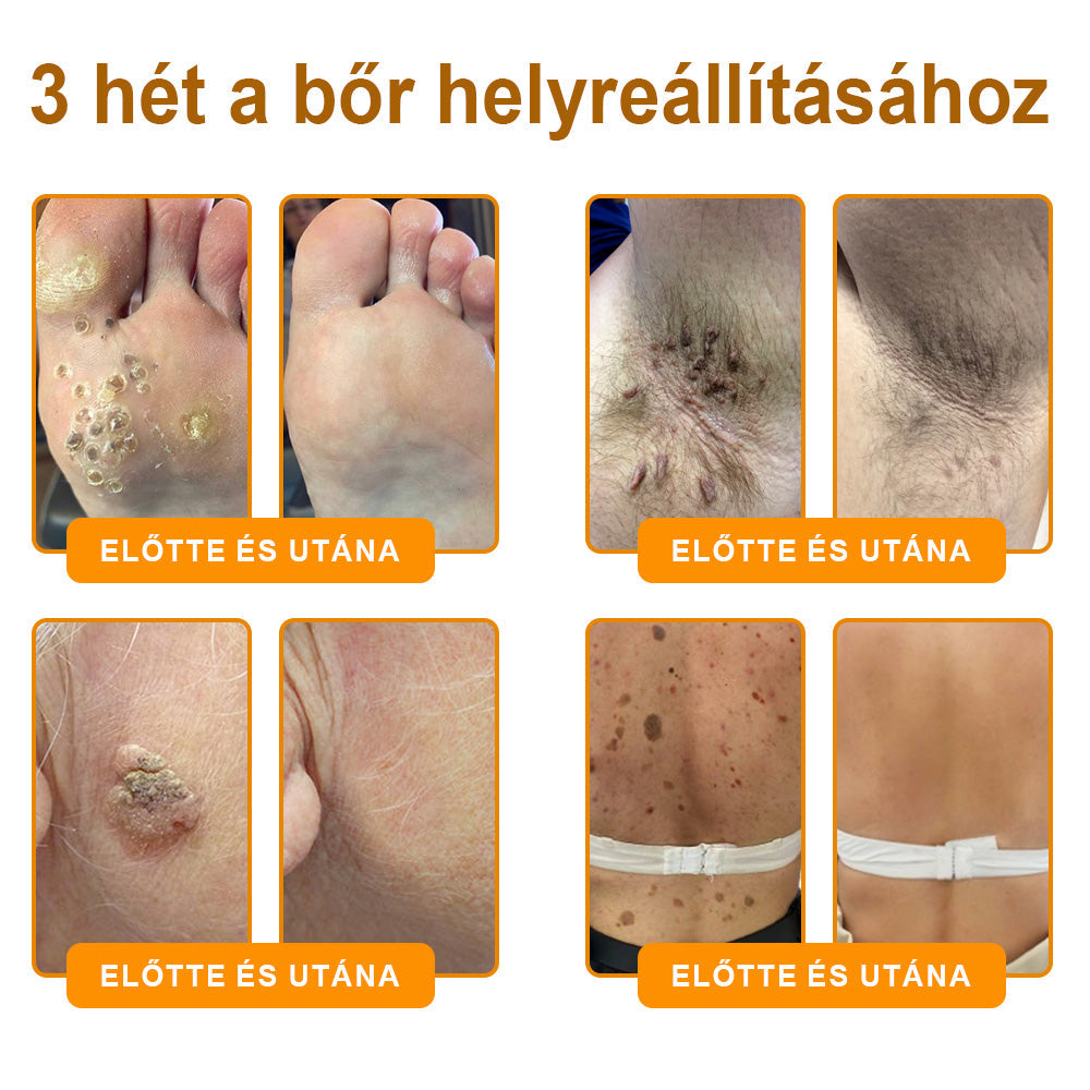Fájdalommentesen és hatékonyan távolítja el a különböző szemölcsökety👨‍⚕️ APKAPK® Méhméreg Bőrmegújító Krém segít eltávolítani a közönséges, talpi, lapos és fonalas szemölcsöket, valamint a papillómákat