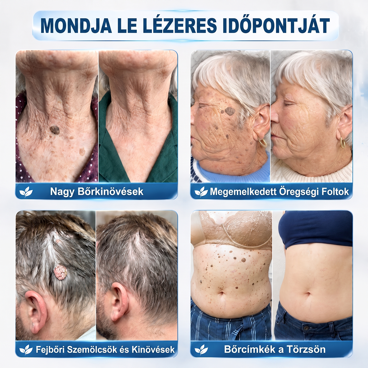 Hivatalos Márkabolt | 🚢 Hiskin® 7 napos Szemölcseltávolító Roll-on Ápoló Folyadék (Fájdalommentes rollerball technológia, hegek nélkül)