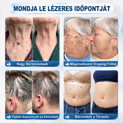 Hivatalos Márkabolt | 🚢 Hiskin® 7 napos Szemölcseltávolító Roll-on Ápoló Folyadék (Fájdalommentes rollerball technológia, hegek nélkül)