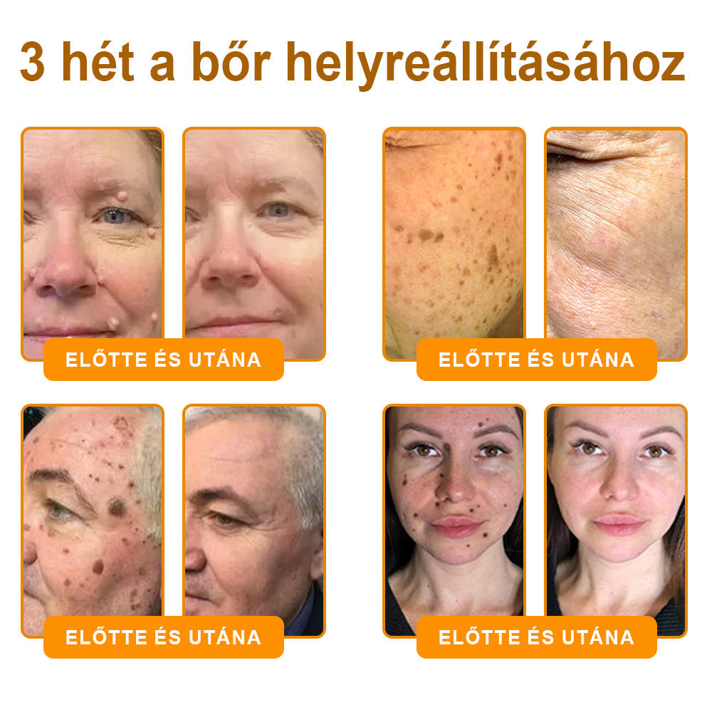 Fájdalommentesen és hatékonyan távolítja el a különböző szemölcsökety👨‍⚕️ APKAPK® Méhméreg Bőrmegújító Krém segít eltávolítani a közönséges, talpi, lapos és fonalas szemölcsöket, valamint a papillómákat
