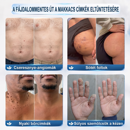 Hivatalos Márkabolt | 🚢 Hiskin® 7 napos Szemölcseltávolító Roll-on Ápoló Folyadék (Fájdalommentes rollerball technológia, hegek nélkül)
