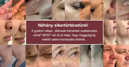 ✨✨✨PURESHADE® 2 az 1-ben mikrotűs és hidrokolloid tapasz🍀 | Kiálló anyajegyek, aknék, lapos szemölcsök és bőrnövedékek eltávolítására | Segít csökkenteni a ráncokat, hegeket és bőrhibákat | Láthatatlan tapasz az arcra és testre