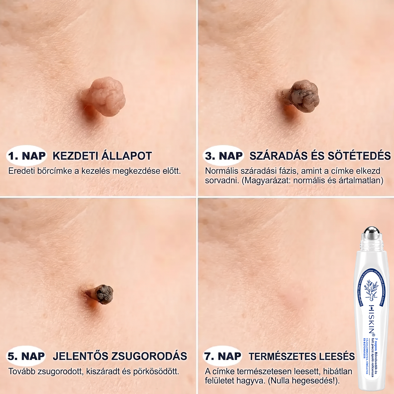 Hivatalos Márkabolt | 🚢 Hiskin® 7 napos Szemölcseltávolító Roll-on Ápoló Folyadék (Fájdalommentes rollerball technológia, hegek nélkül)