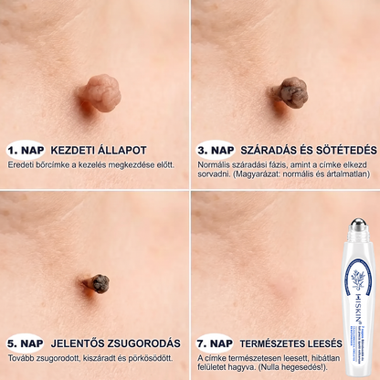 Hivatalos Márkabolt | 🚢 Hiskin® 7 napos Szemölcseltávolító Roll-on Ápoló Folyadék (Fájdalommentes rollerball technológia, hegek nélkül)