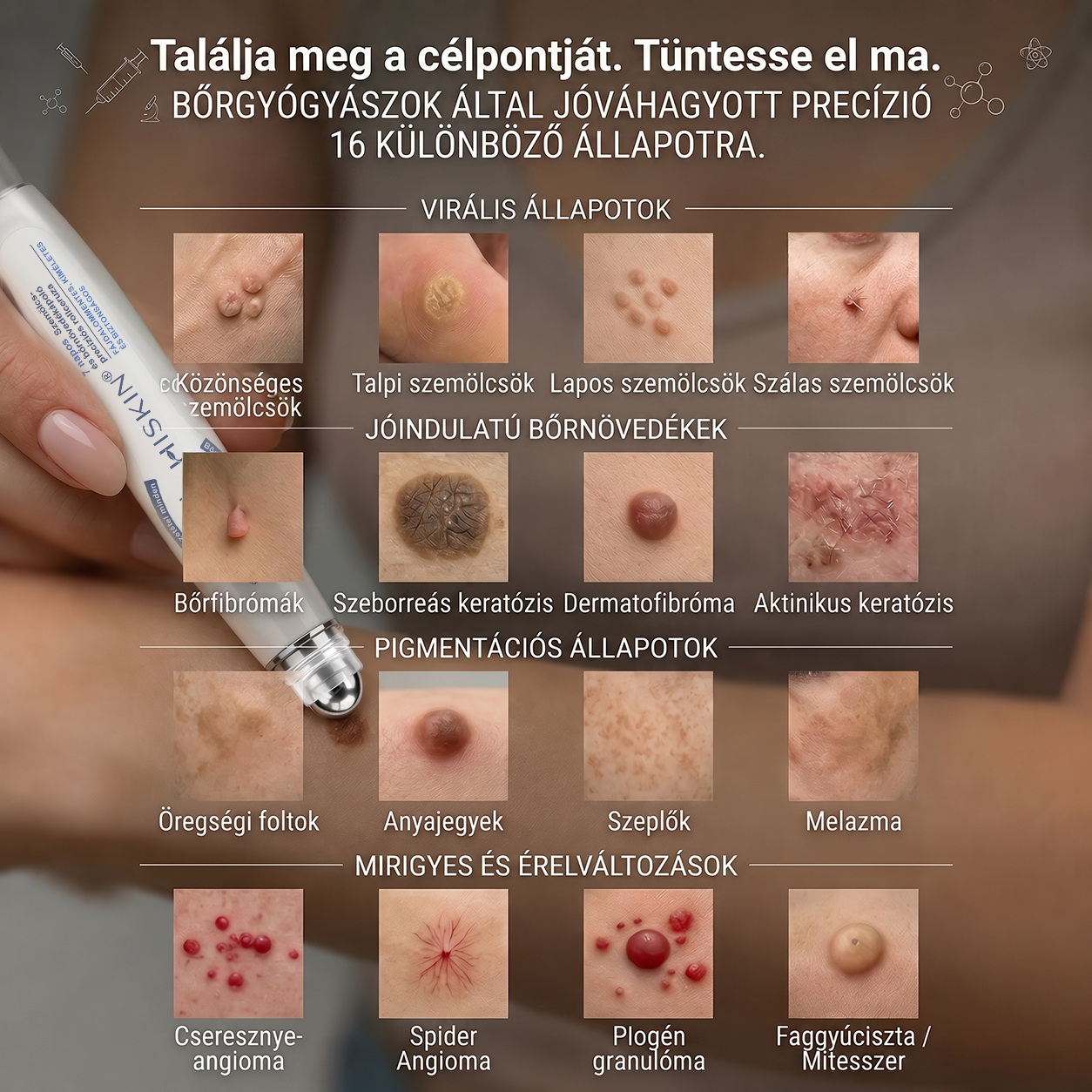 Hivatalos Márkabolt | 🚢 Hiskin® 7 napos Szemölcseltávolító Roll-on Ápoló Folyadék (Fájdalommentes rollerball technológia, hegek nélkül)